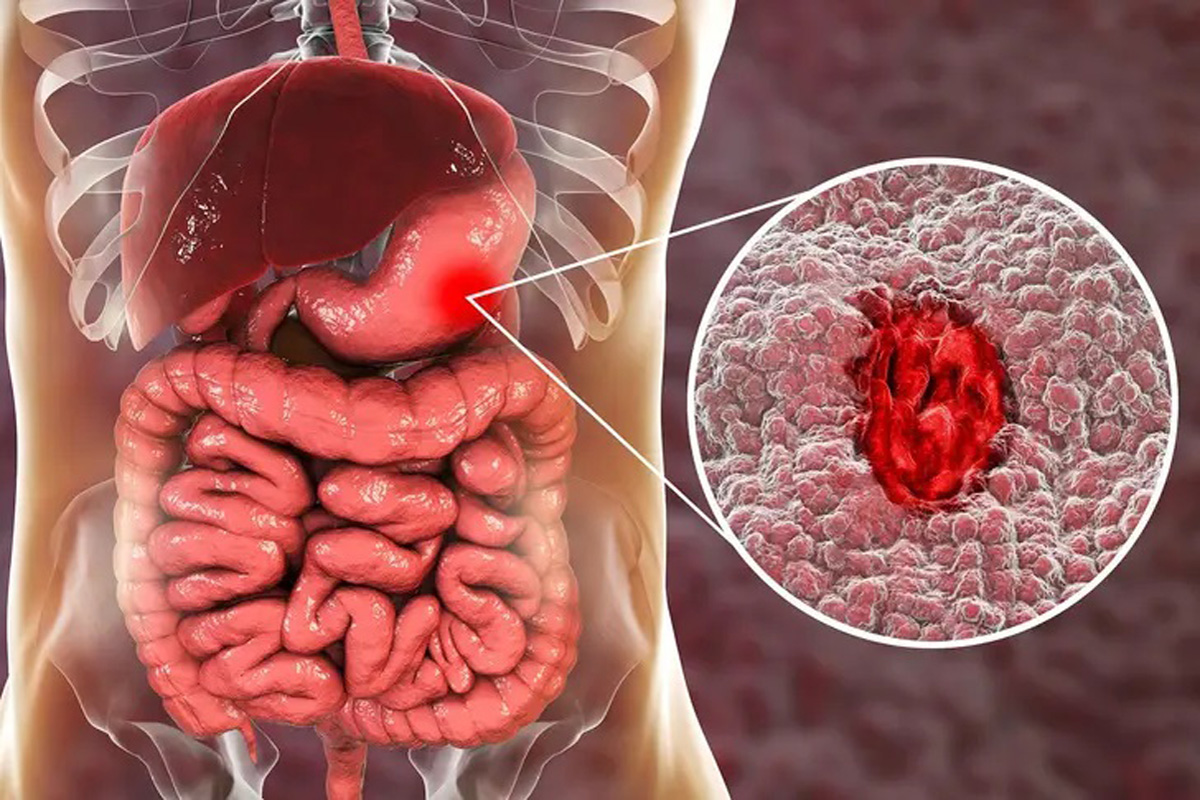 زخم معده چگونه به وجود می آید؟ علائم، پیشگیری و درمان
