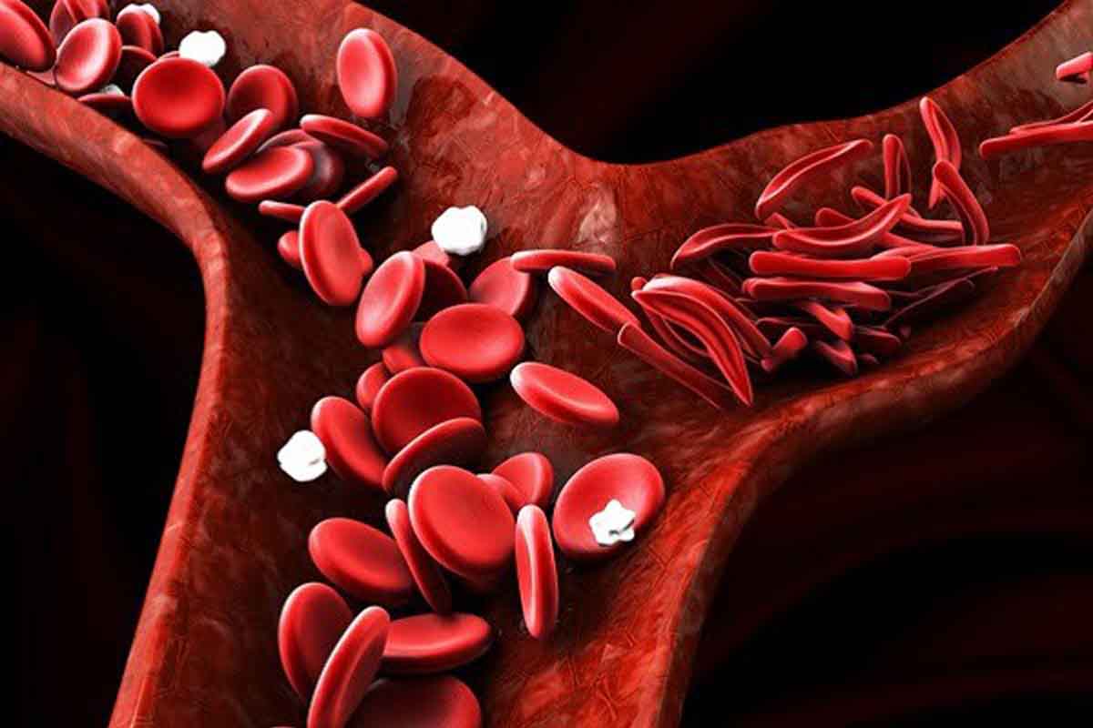 تالاسمی چیست؟ علائم و روش های تشخیص و درمان