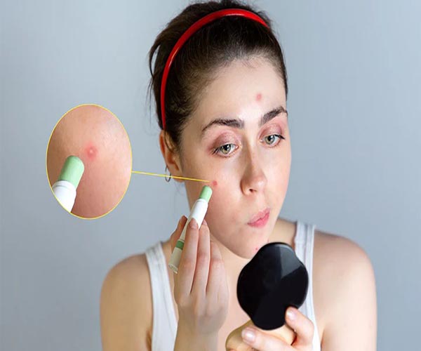 کنترل طبیعی جوش ها